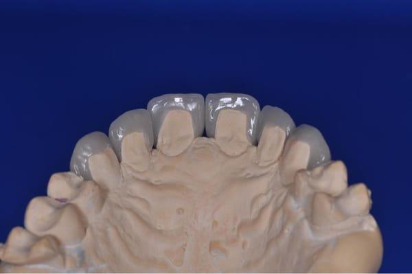 Emax veneers