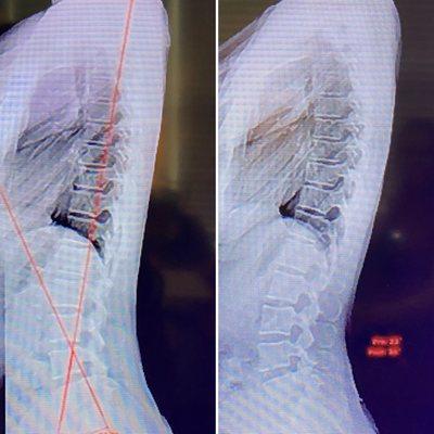 My personal x ray on lower back after 3 months. I didn't have any curve in my spine prior to being seen.