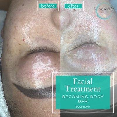 Facial treatment