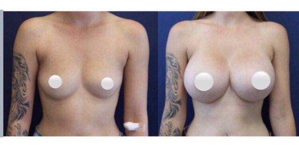 Before and After Breast augmentation- silicone implants, 560 cc High Profile