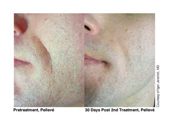 Pelleve Wrinkle Reduction