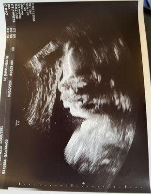 34 week ultrasound, Mirarose was thriving with an average weight & a significant amount of hair!