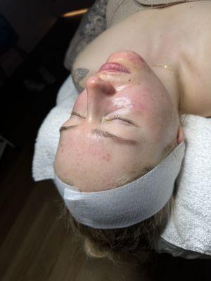 Acne Facial with Chemical Peel