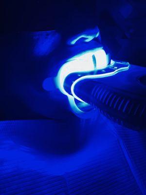 Our teeth whitening treatment with our signature whitening gel activated by LED laser lights