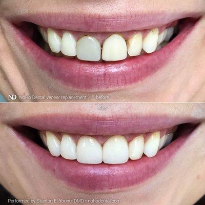 Dr. Young replaced this patient's old dental veneers, restoring a bright and natural smile.