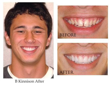 Cosmetic Dentistry. Before and after