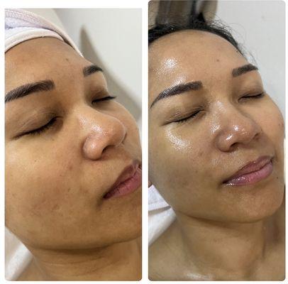 Before/after facial