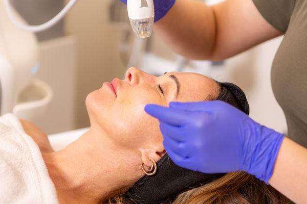 VirtueRF Microneedling laser treatment