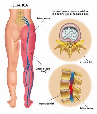 3 Types of Massage Therapy for Sciatica Pain Relief
Deep Tissue Massage, Myofascial Release Therapy,Trigger Point Therapy