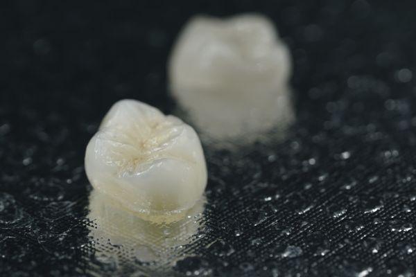 Emax Crowns