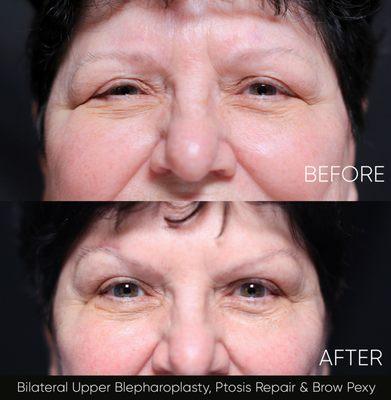 Eye Lid surgery and brow lift