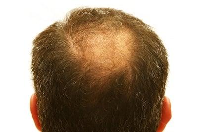 hair loss - male pattern baldness