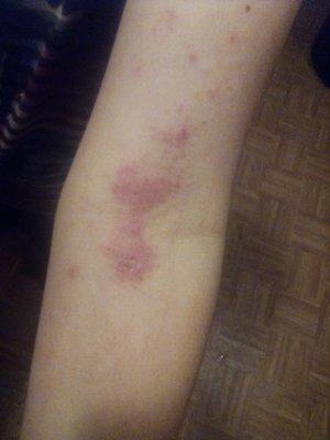 my daughter has sensitive skin, rash from bites,itching