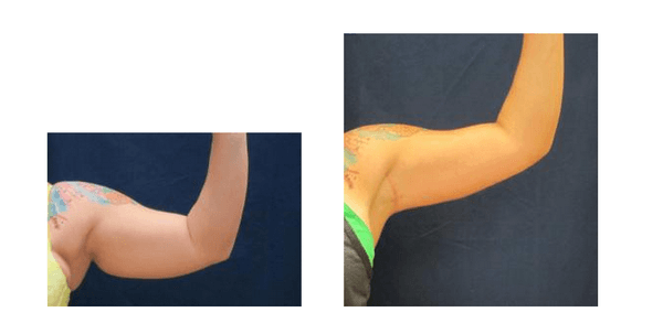 Before & after photo of our arm lift procedure