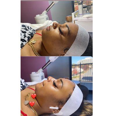 Before and after if a chemical peel