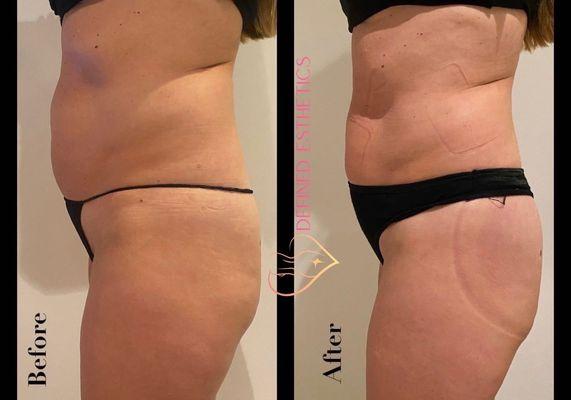 4 treatments of Lipo cavitation, Laser pads, and BBL sessions.