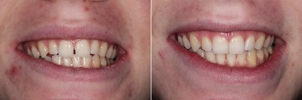 Before and After of Invisalign