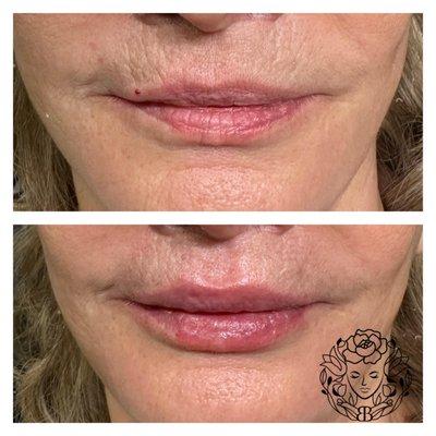 Lip filler on our beautiful patient to give her that extra pout!