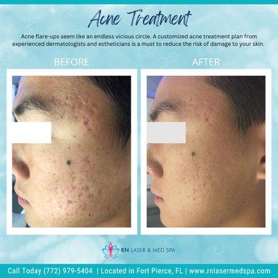 Acne Treatment