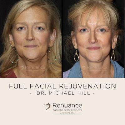 Before and after full facial rejuvenation