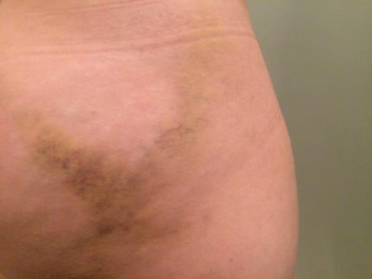 The big-ass bruise Mike left me with.