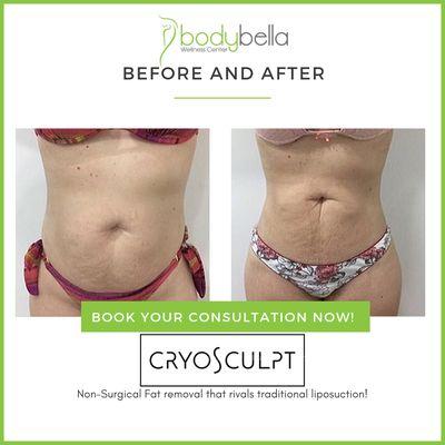 CryoSculpt 45 day before and after of abdomen