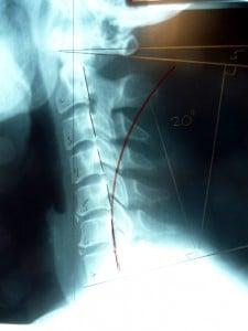 This is case NC before treatment. Note the vertebra lean away from the red arc that indicates their proper position.