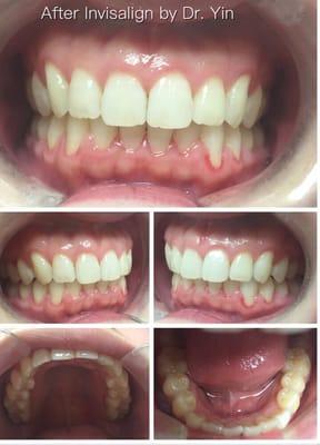 Dr. Yin has been provided Invisalign treatment to patient for more than10 years. Here is one case after 20 weeks treatment .