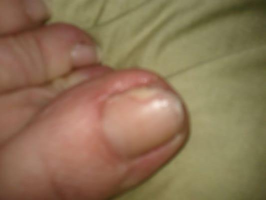 Toe fungus from this place. Left toe