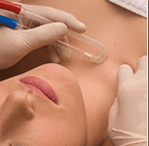 Microdermabrasion