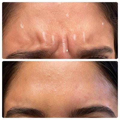 Before & After
Botox Treatment