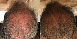 Male Patient after 4 month of treatment