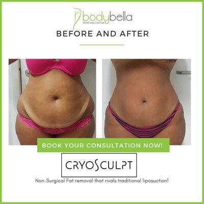 CryoSculpt 45 day before and after of abdomen and love handles.