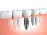 We place and restore Dental Implants