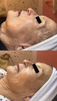 Microneedling- significant reduction in deep wrinkles around eyes and lower face. Improved overall skin texture, tone.