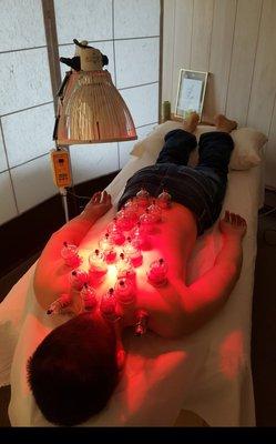 Acupuncture + Cupping treatment with infrared heat therapy.