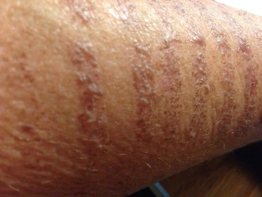 Blisters on my arm. Tiger striped burning from a laser that was set too high.