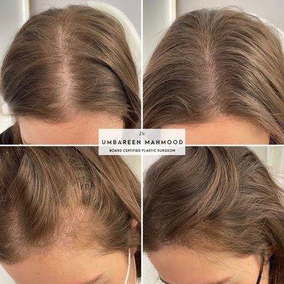 Non-surgical treatment for thinning hair