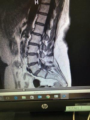 lower back pain from a disc injury as seen on this mri