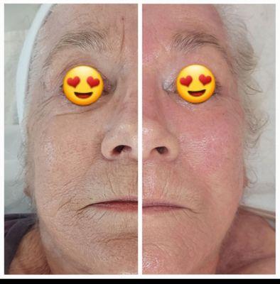 Filler Facial