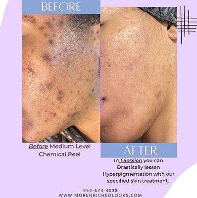 Before & After Chemical Peel