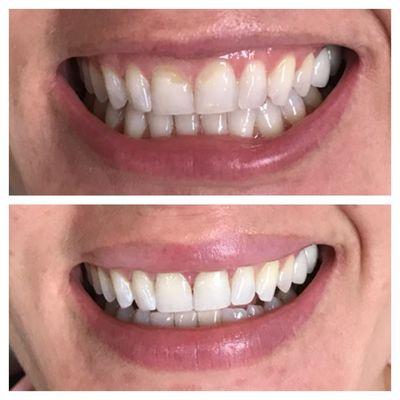 A conservative cosmetic option- direct bonding with almost no removal of natural tooth structure, and completed in one short visit!