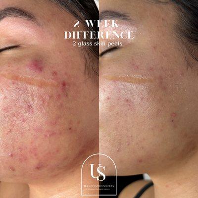 Biorepeel AKA glass skin peel 2 weeks apart