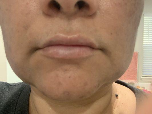 After lip filler, 7/17/23, about 2 1/2 hours later