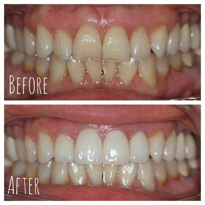 Smile transformation with 4 veneers