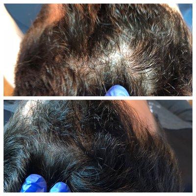 PRP for hair restoration. After pic taken 4 week after first treatment