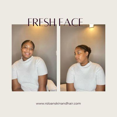 It's the after glow of our teen facials to rebalance the skin and minimize break outs .