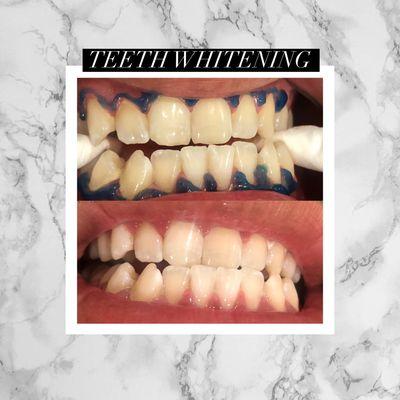 Teeth whitening