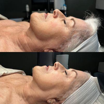 Firming peptide facial (before on top, after on bottom)