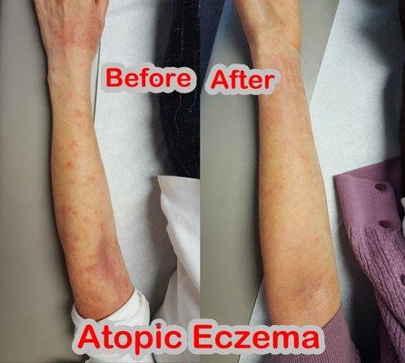 Atopic Eczema